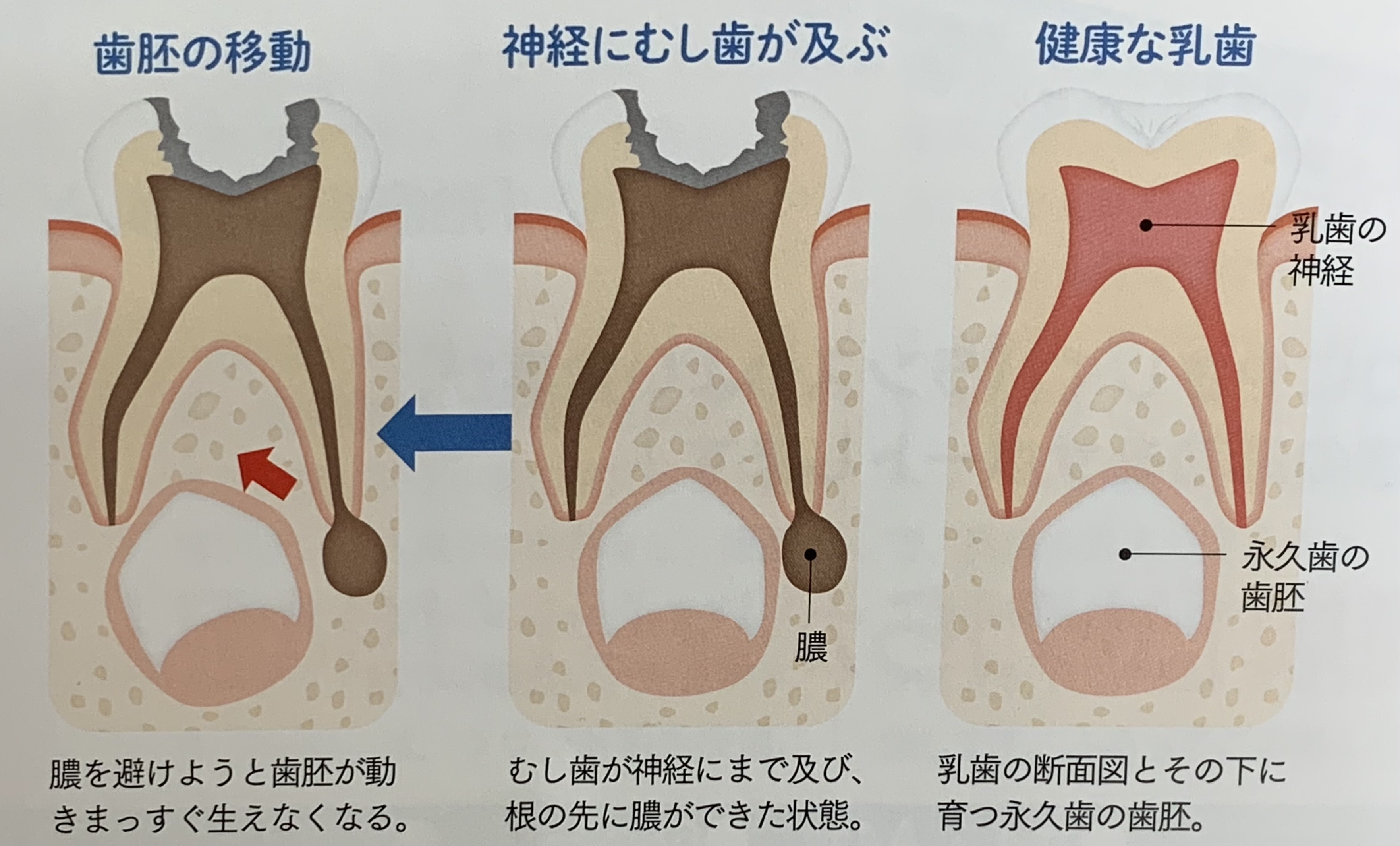 乳歯 虫歯 永久歯 へ の 影響