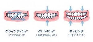 歯ぎしり